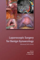 Laparoscopic Surgery for Benign Gynaecology Hardback with DVDs - Alfred CutnerSanjay Vyas (ISBN: 9781906985318)