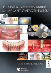 Clinical and Laboratory Manual of Implant Overdentures - Hamid Shafie (ISBN: 9780813808819)
