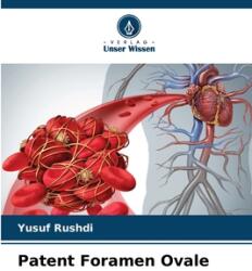 Patent Foramen Ovale (ISBN: 9786208238636)