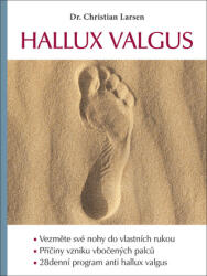 Hallux valgus (2022)
