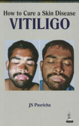 How to Cure a Skin Disease: Vitiligo - J. S. Pasricha (2014)