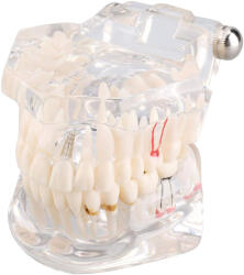 Verk Group Model anatomic de dinte cu implanturi pentru educație orală și demonstrații (01964_B)