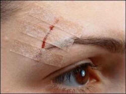 Steri-strip 6 x 75 mm bőrzáró csík 3 db csík/ív (8888)