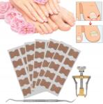  Benőtt Köröm Korrektor (1411200455411)