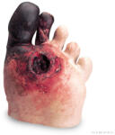Erler Zimmer Egészségtelen lábfej modell (MO-R10027)